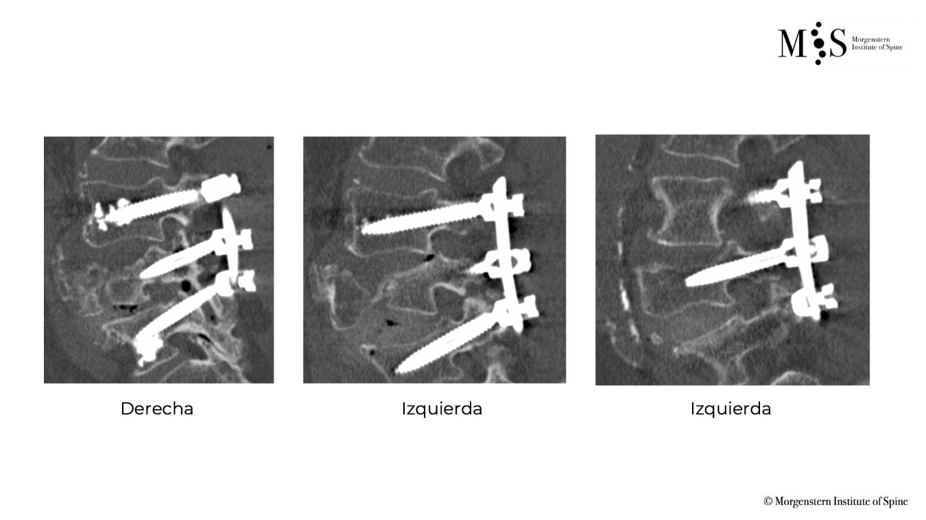 Fracturas Vertebrales Centro Médico Teknon