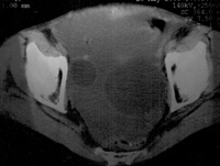 Cáncer de ovario (resonancia magnética nuclear)