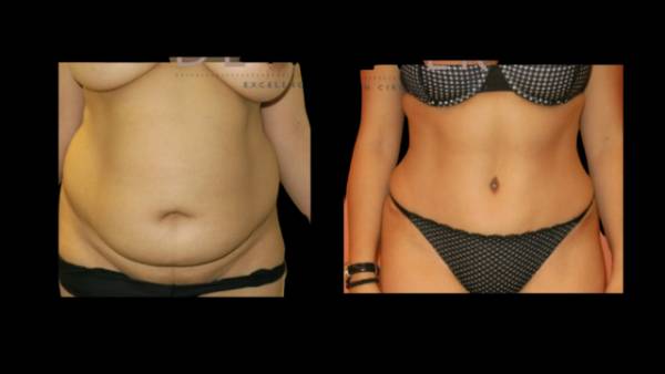 Abdominoplastia Dr dewever felix chavarria teknon