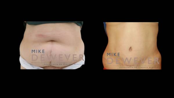 Abdominoplastia Dr dewever felix chavarria