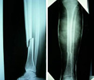 Fracturas de tibia y peroné