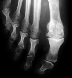 hallux rígidus