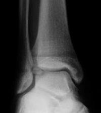 Lesiones-osteocondrales-tob