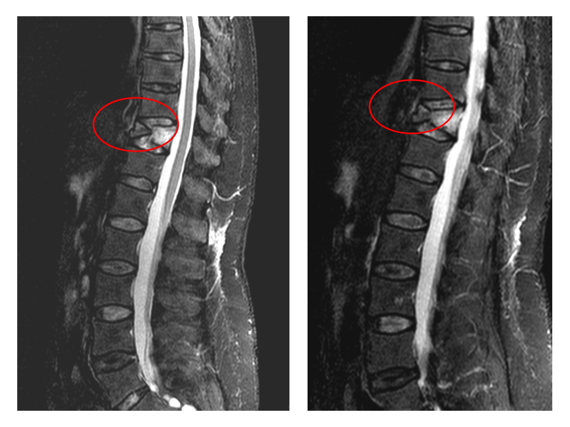 Fracturas Vertebrales Centro Médico Teknon 5889