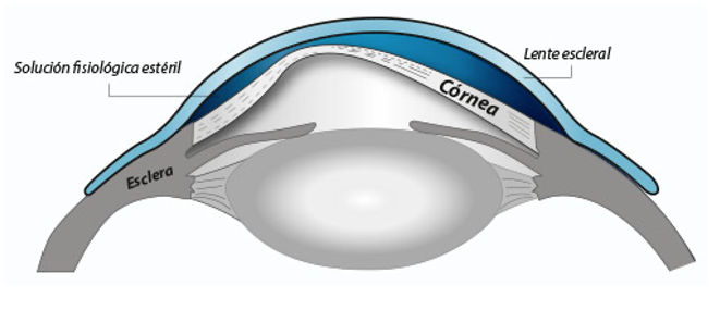 Lentillas cheap rígidas queratocono