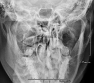 Radiografia de maxilar y mandibula