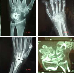 Tratamiento de artrosis de manos en Clínica Luis Baños ®