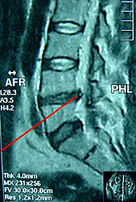 Hernia discal lumbar Centro M dico Teknon