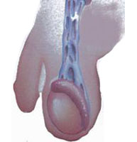 Suspensorio Testicular Post Operatorio